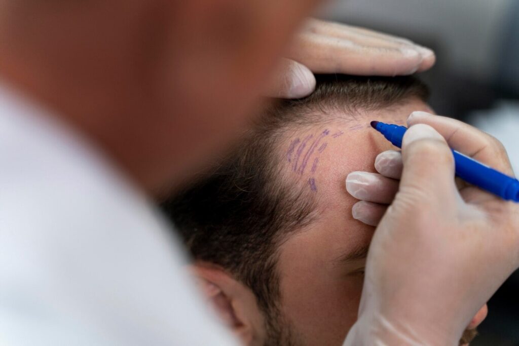 scalp micropigmentation