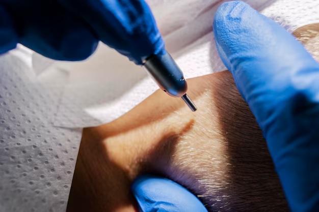 Tattoo Removal Pain: What to Expect and How to Manage It